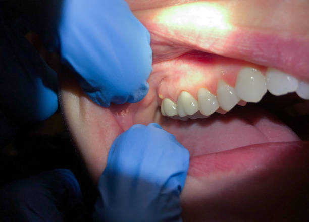 Best Emergency Tooth Extraction in Canastota, NY